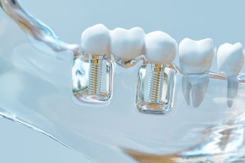 3D Model of Dental Implant — Bloomingdale, IL — Dr Boyer & Scheive, DDS