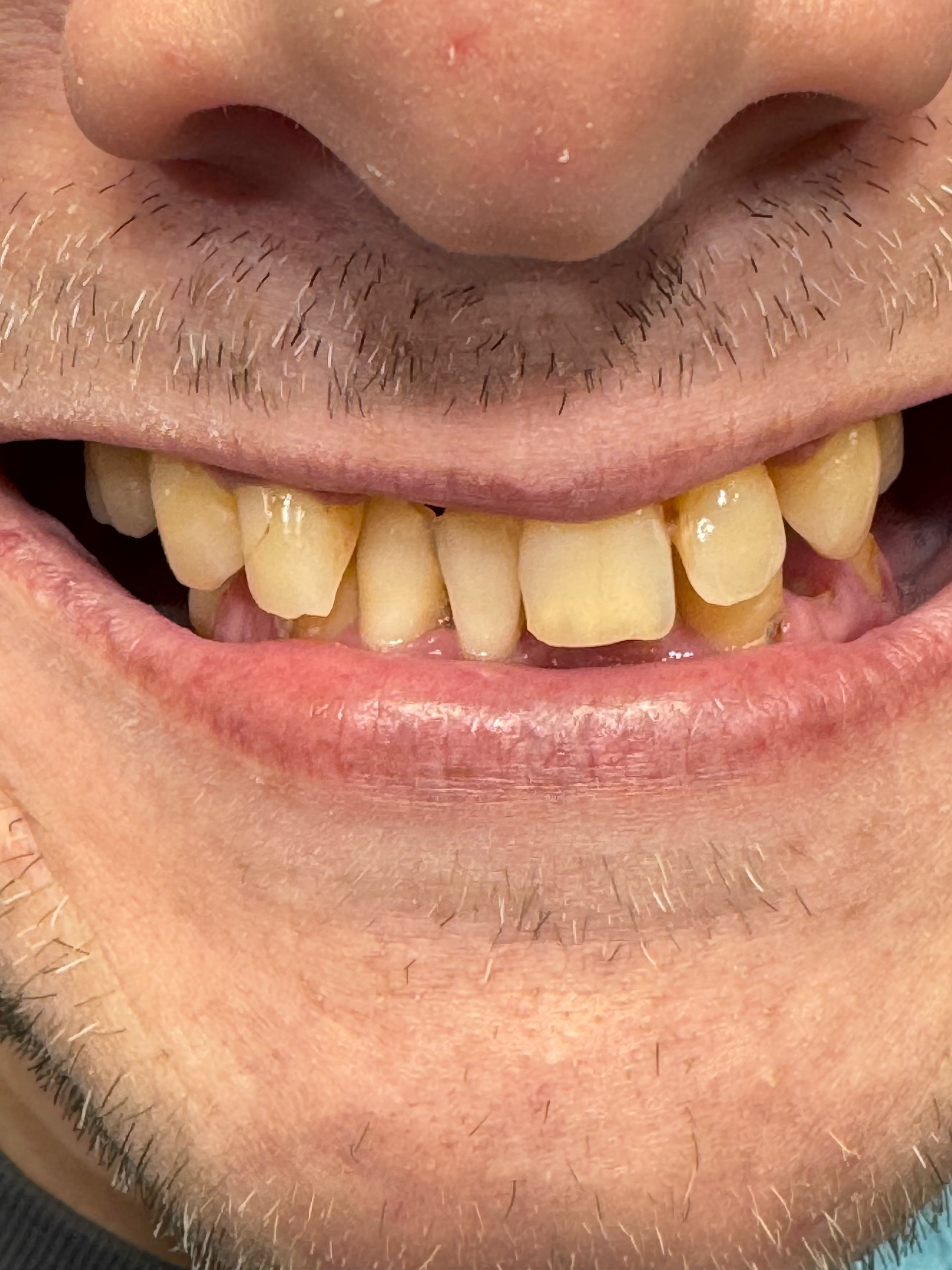 A close up of a man 's mouth with a beard and teeth.