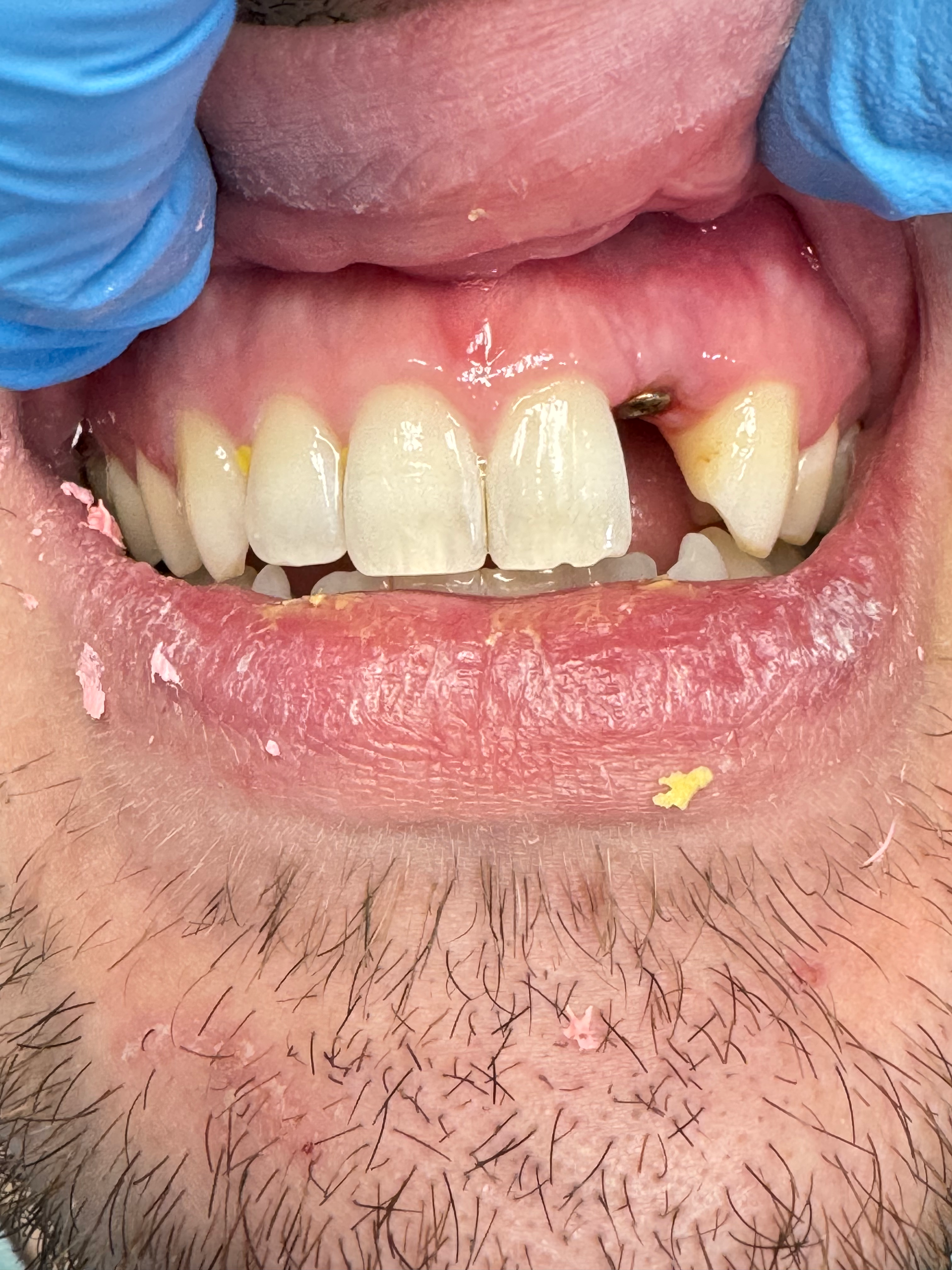 A close up of a man 's mouth with a missing tooth.