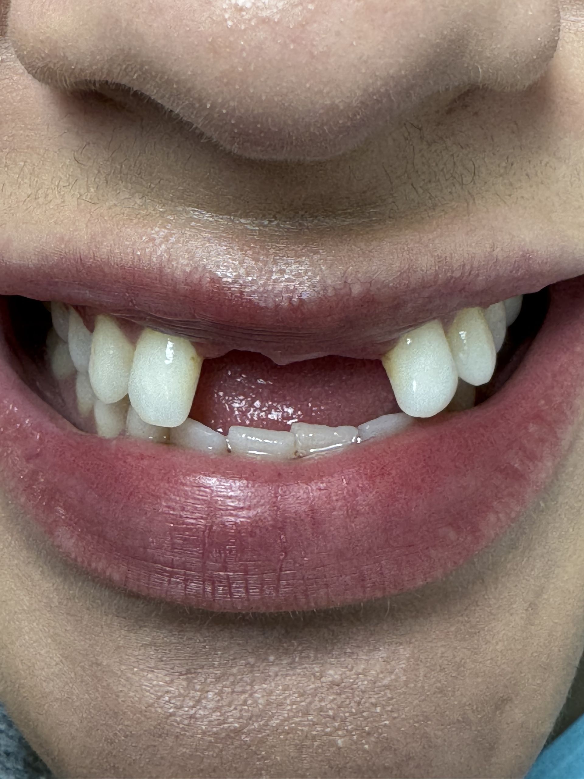 A man with a beard is smiling in a dental chair.