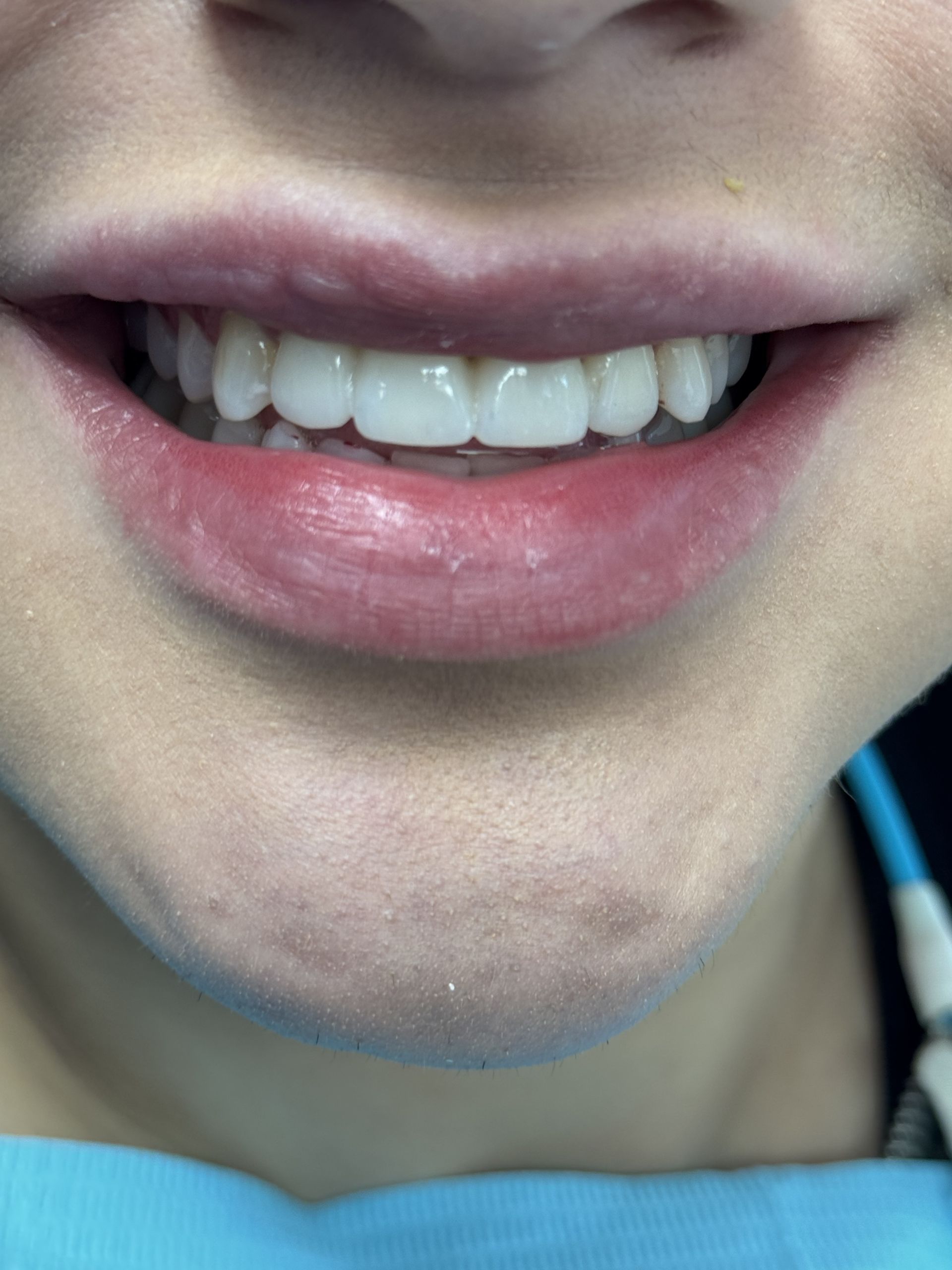 A close up of a man 's mouth with a missing tooth.