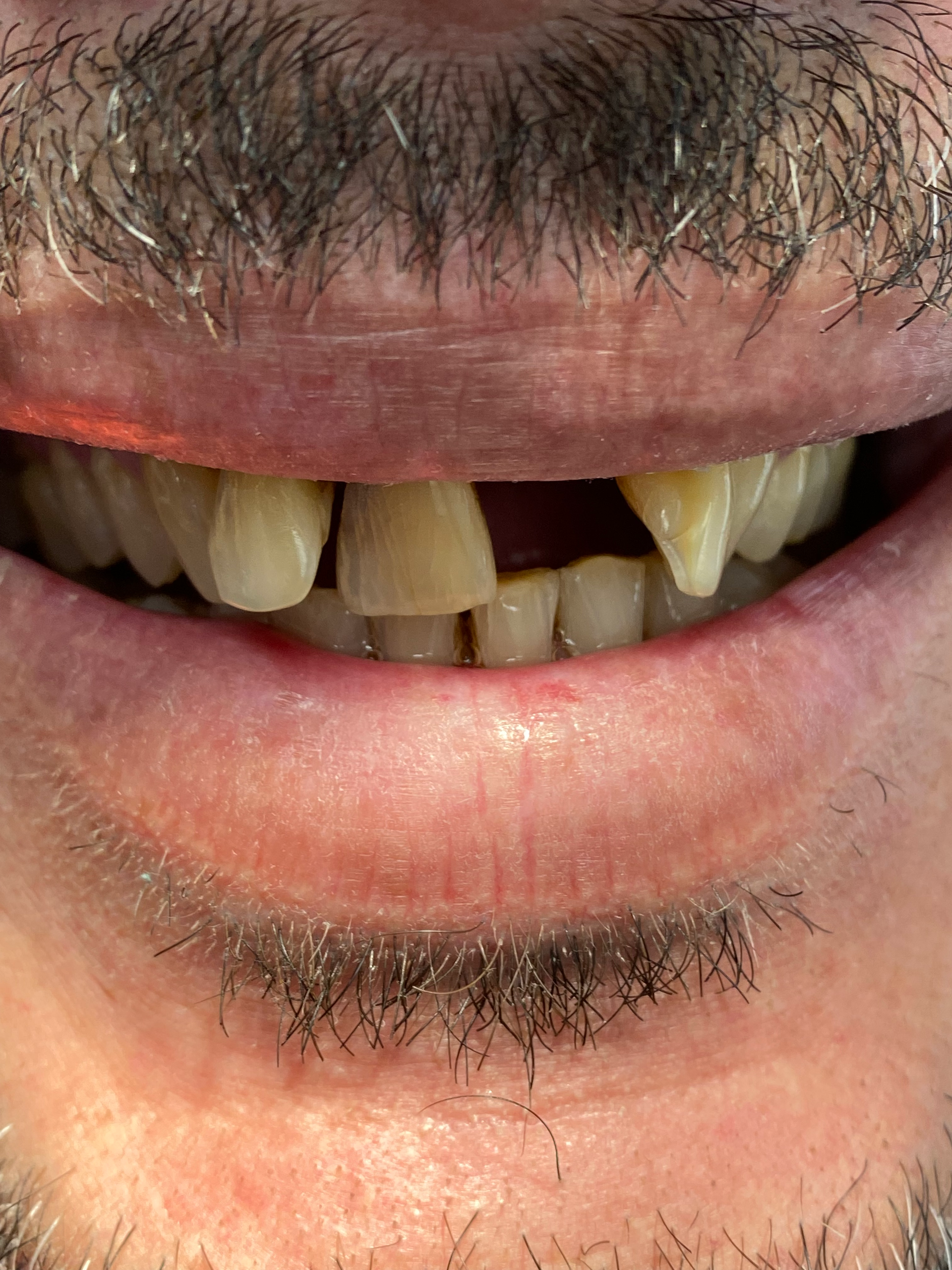 A close up of a man 's mouth with missing teeth and a beard.