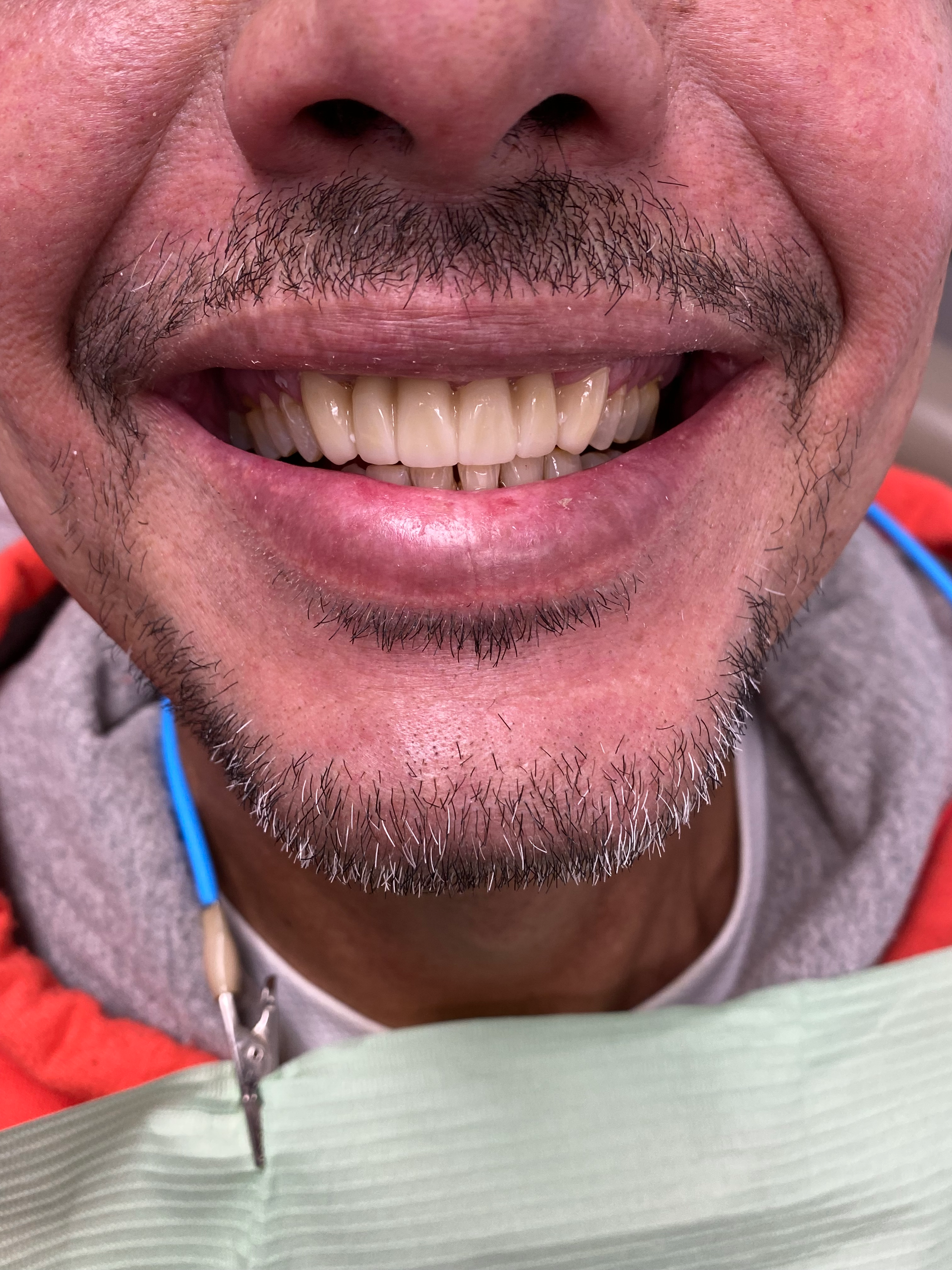 A man with a beard is smiling in a dental chair.