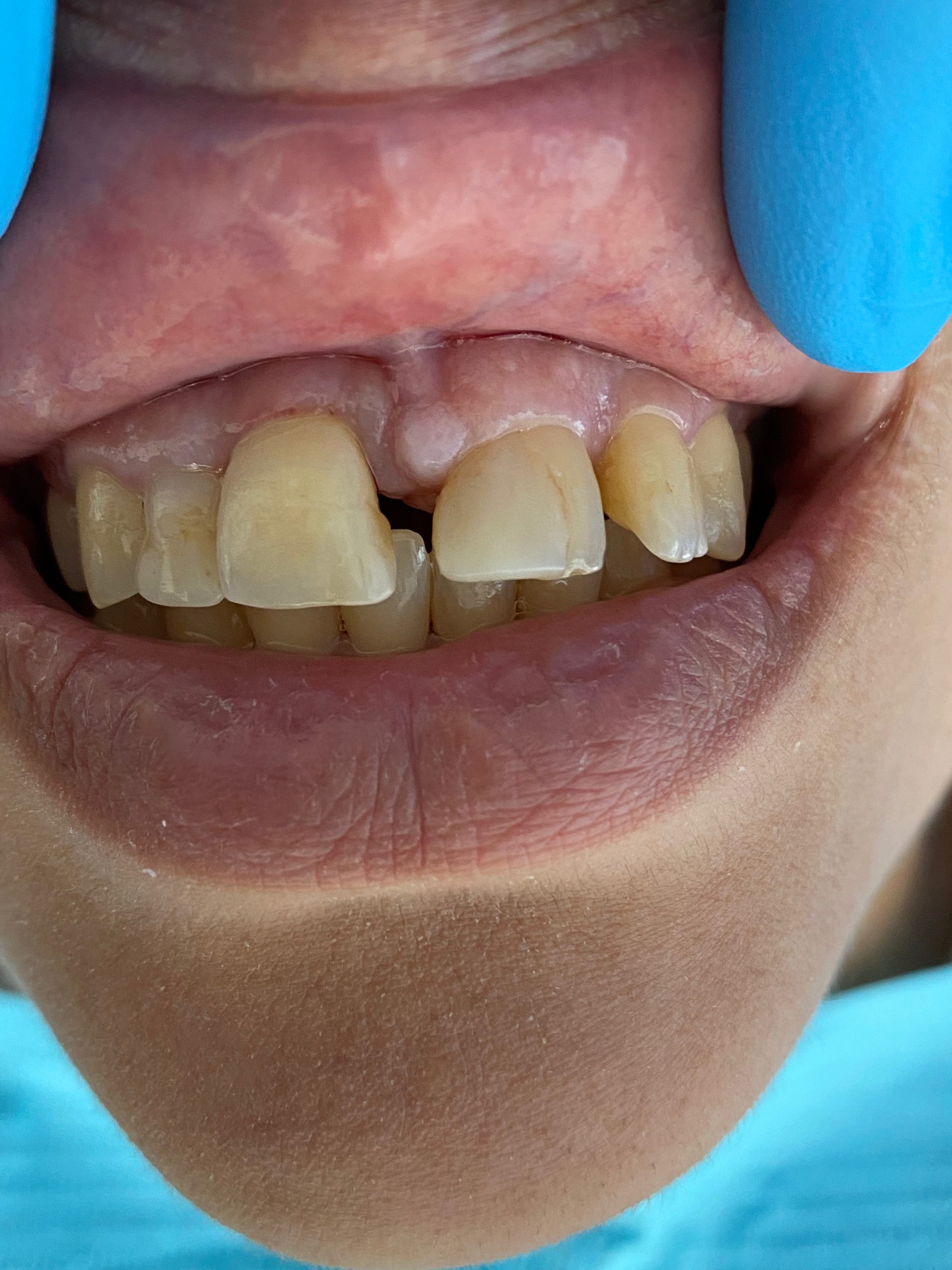 A close up of a person 's mouth with a missing tooth.