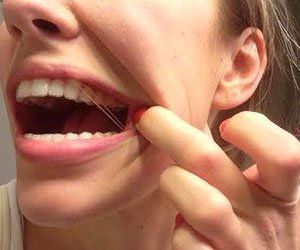 What Are Invisalign Rubber Bands?