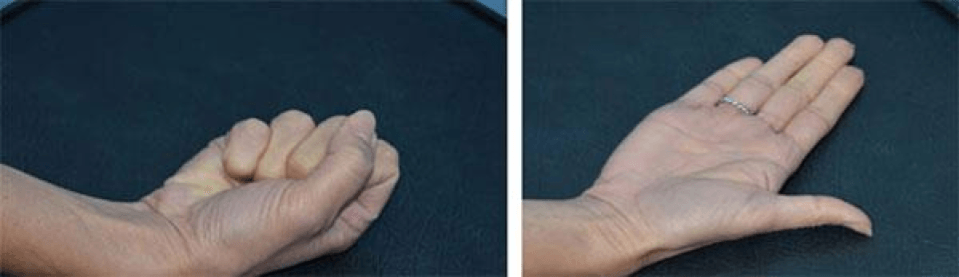 Hand Squeeze exercise
