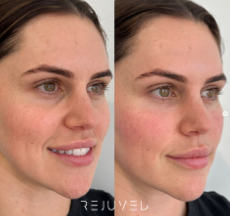 A Before and After Photo of A Woman 's Face — Rejuved in Bateau Bay, NSW