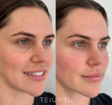 A Before and After Photo of A Woman's Face with And without Makeup — Rejuved in Bateau Bay, NSW