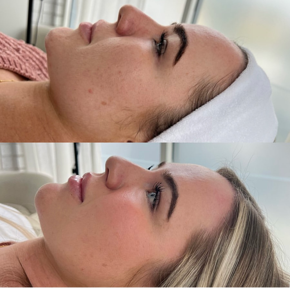 A Before and After Picture of A Woman's Face — Rejuved in Bateau Bay, NSW