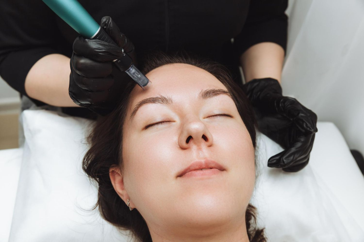 Woman receiving facial micro-needling treatment. Practitioner's gloved hands use a device on her forehead, she has eyes closed, laying down.