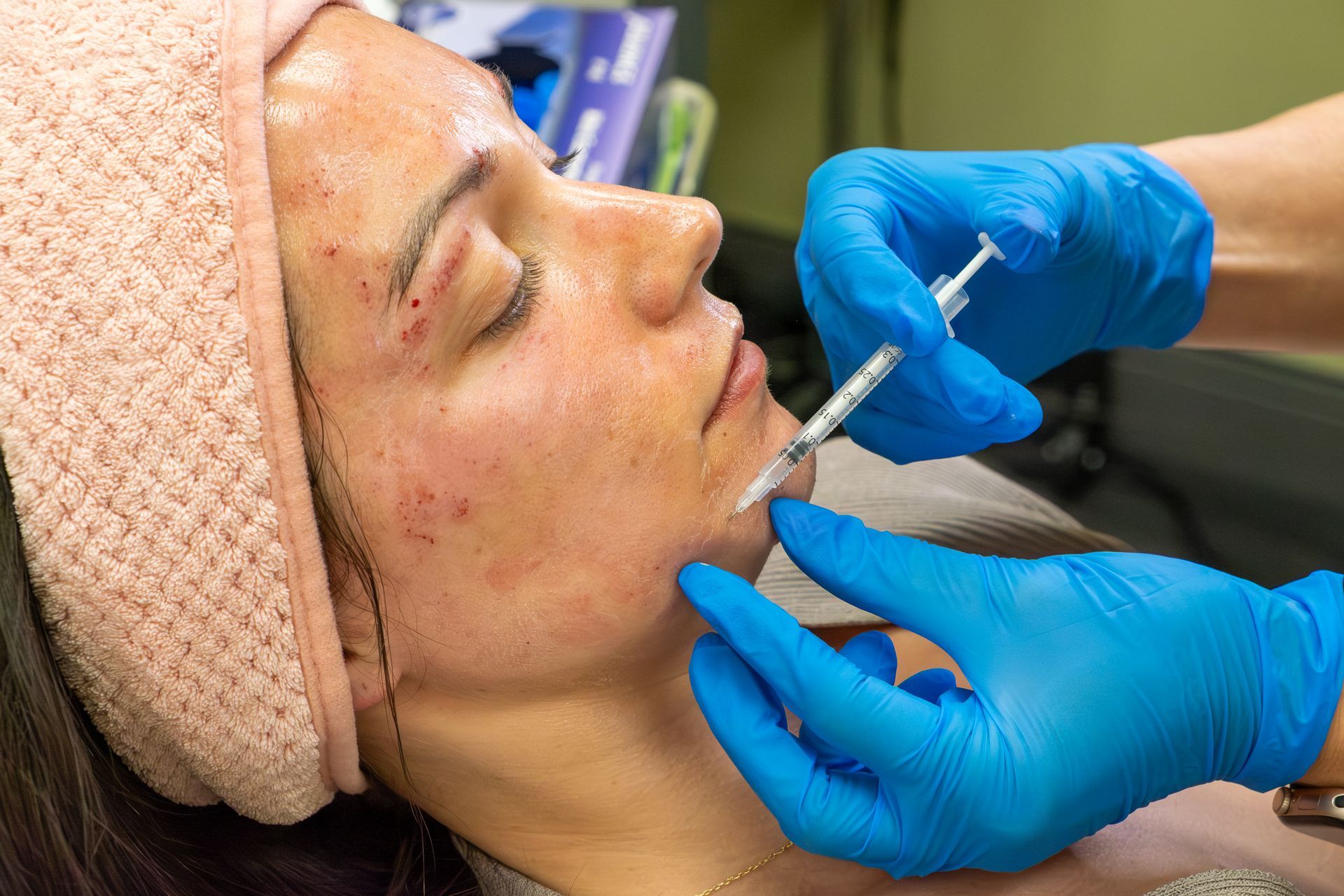 Gloved clinician injects filler into a woman’s chin during a cosmetic procedure