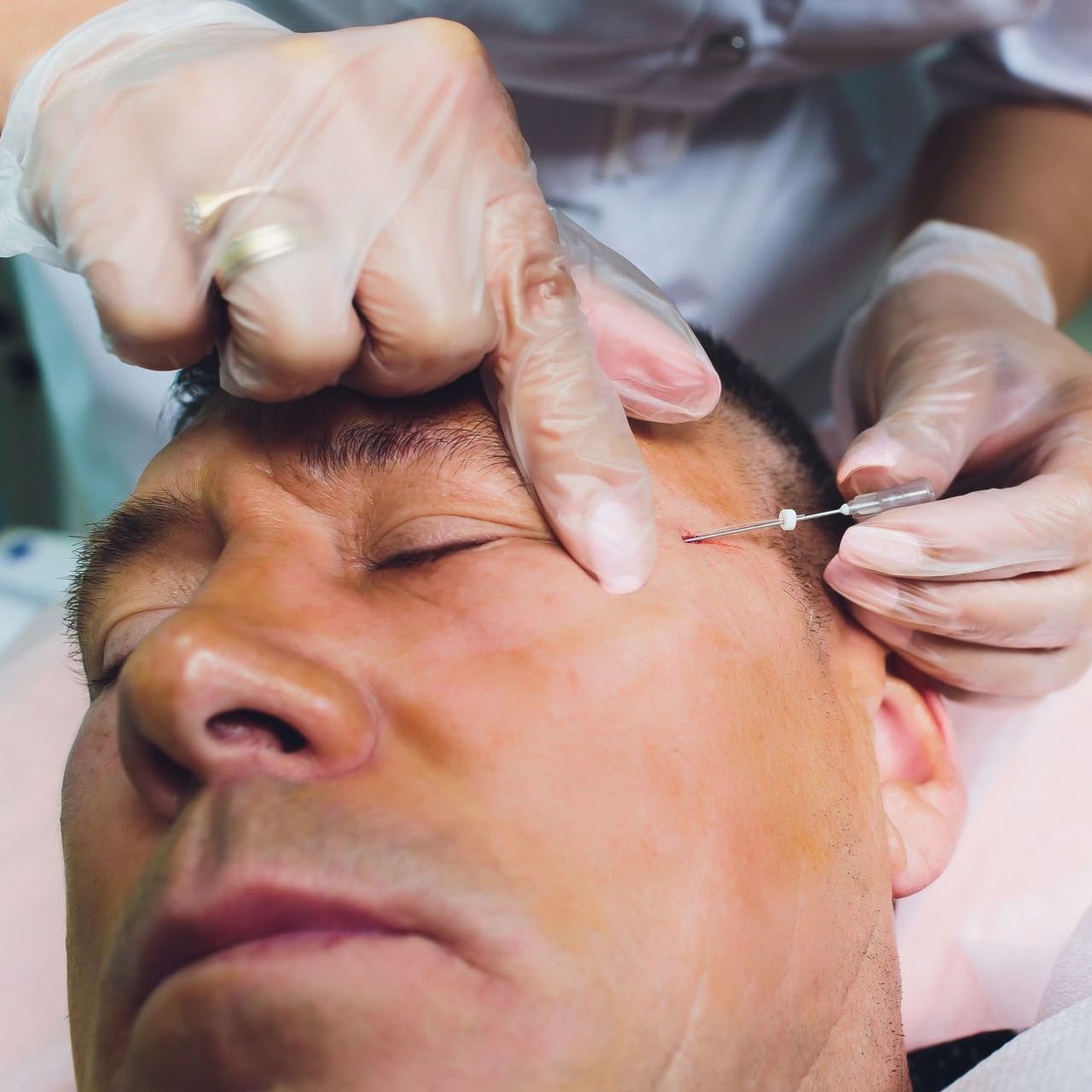 A man is getting a botox injection in his forehead.