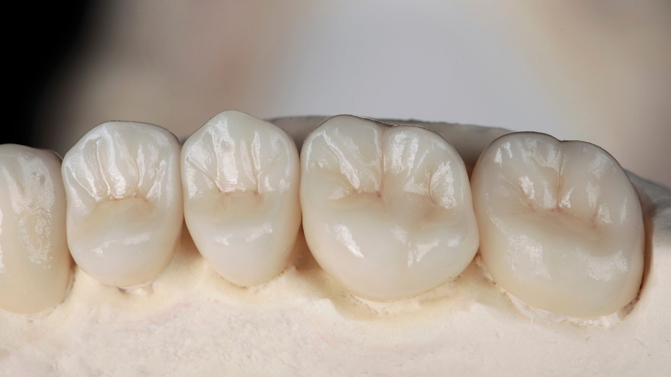 Dental cast of four artificial white teeth with natural-looking texture.
