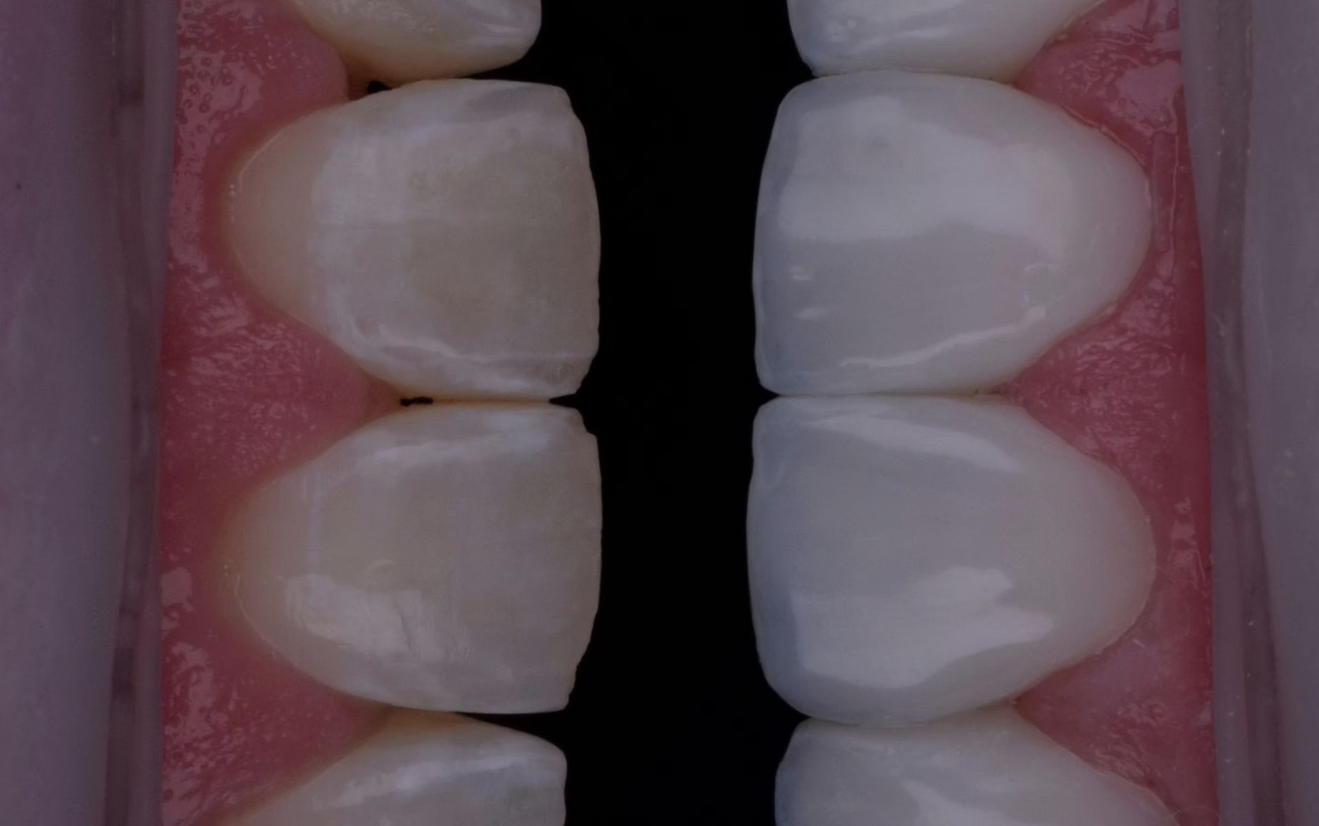 Close-up of human teeth, showing healthy gums and white enamel.