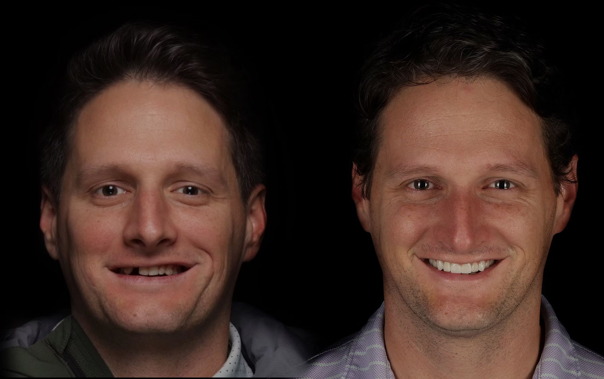 Before and after photos of a man with missing teeth, then with a full, white smile.