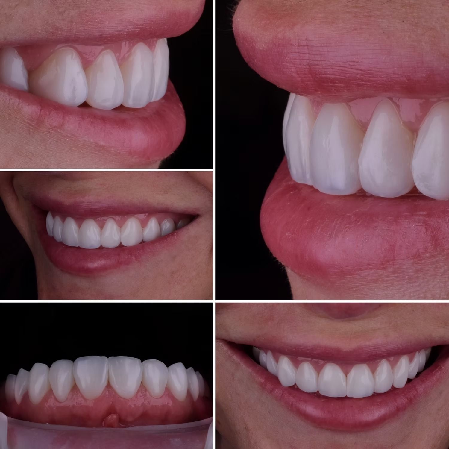 Close-up of teeth in five different views; smiling woman, teeth are white, lips are pink.