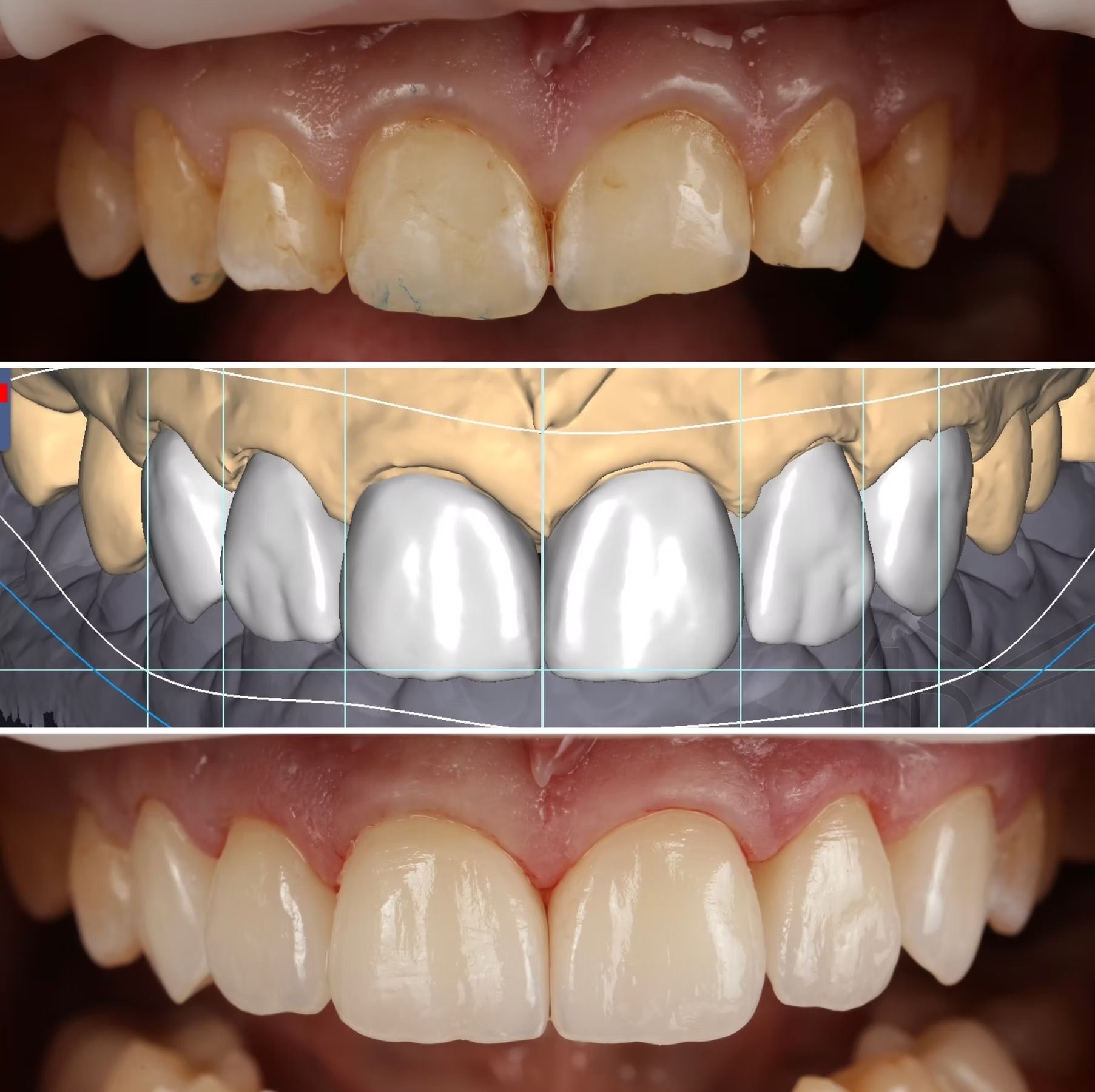 Before and after dental veneer treatment. Shows stained teeth, digital design, and brightened smile.