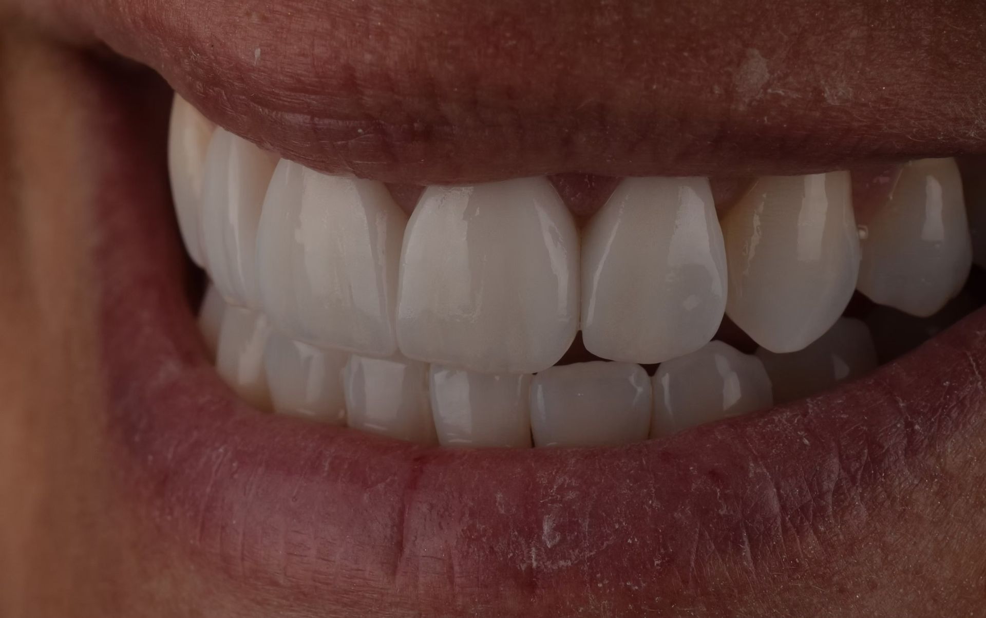 Close-up of a smiling mouth with bright white teeth. Pink lips and skin are also visible.
