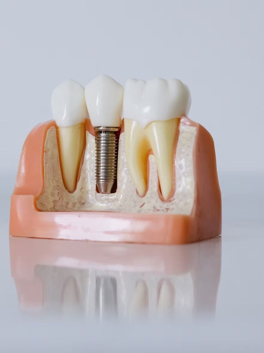 Dental model showing a tooth implant between two natural teeth, with a sectioned view of gums and roots.