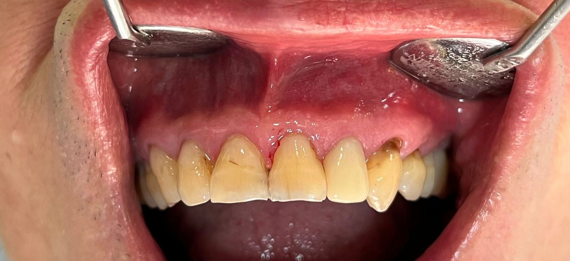 Eine Nahaufnahme des Mundes einer Person mit einem Zahnarztspiegel darin.