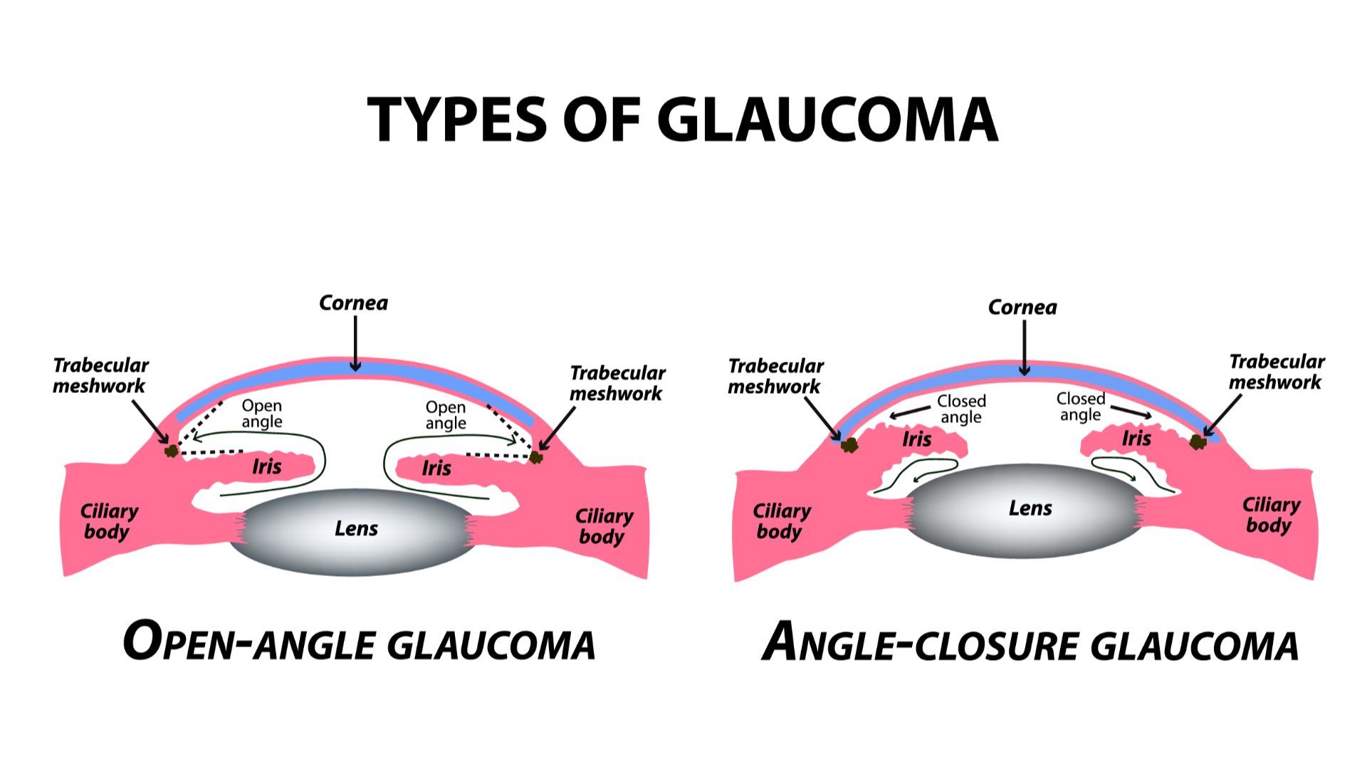 how-long-does-it-take-to-go-blind-from-glaucoma