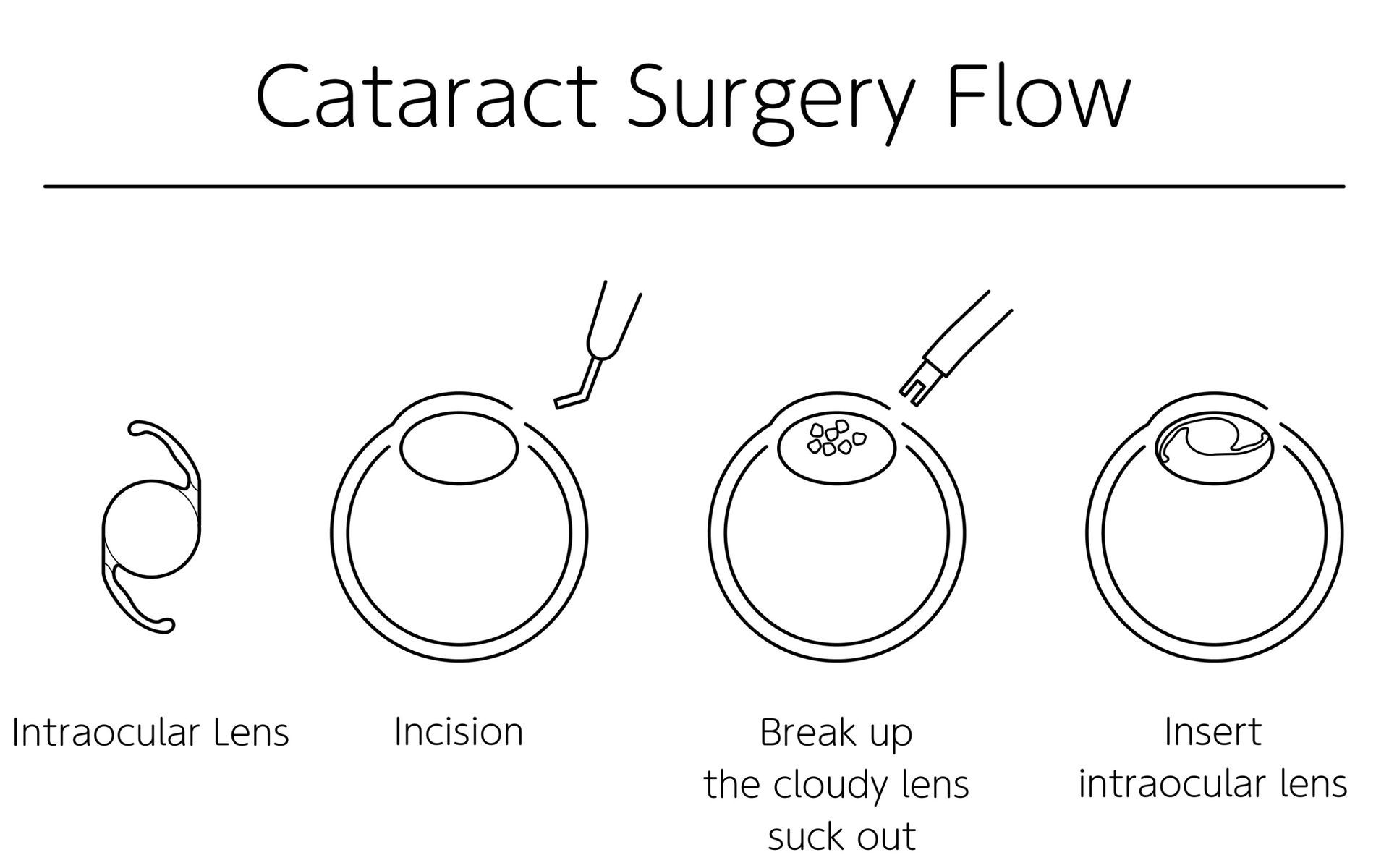 How Long Does Cataract Surgery Take?