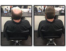 Before and After hair loss