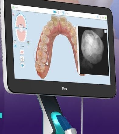 itero digital orthodontic display