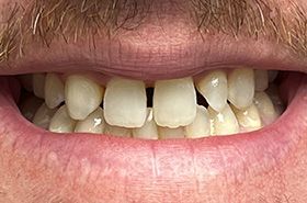 A close up of a man 's teeth with a beard.