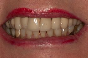 A close up of a woman 's mouth with white teeth and red lipstick.