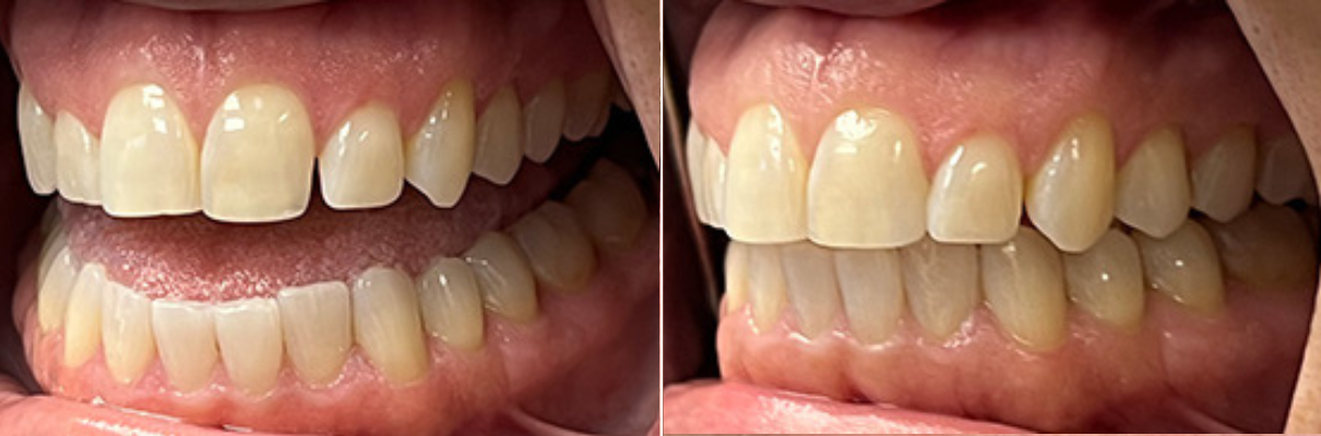 A before and after picture of a person 's teeth.