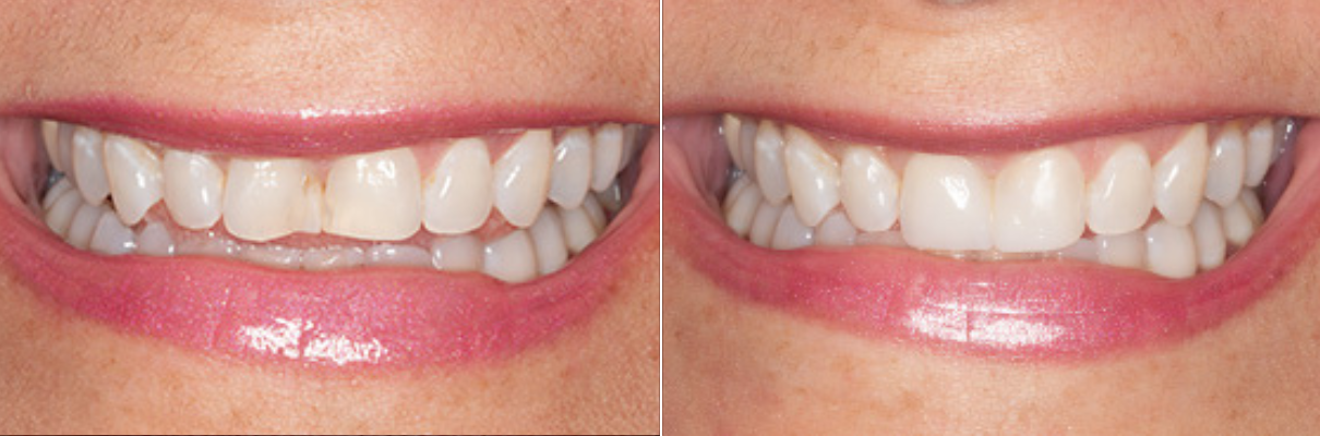 A before and after picture of a woman 's teeth.