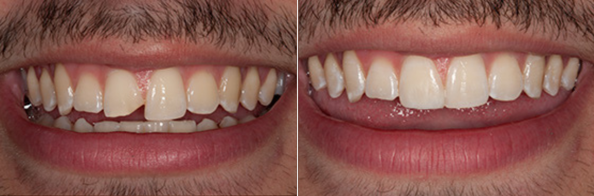 A before and after picture of a man 's teeth.