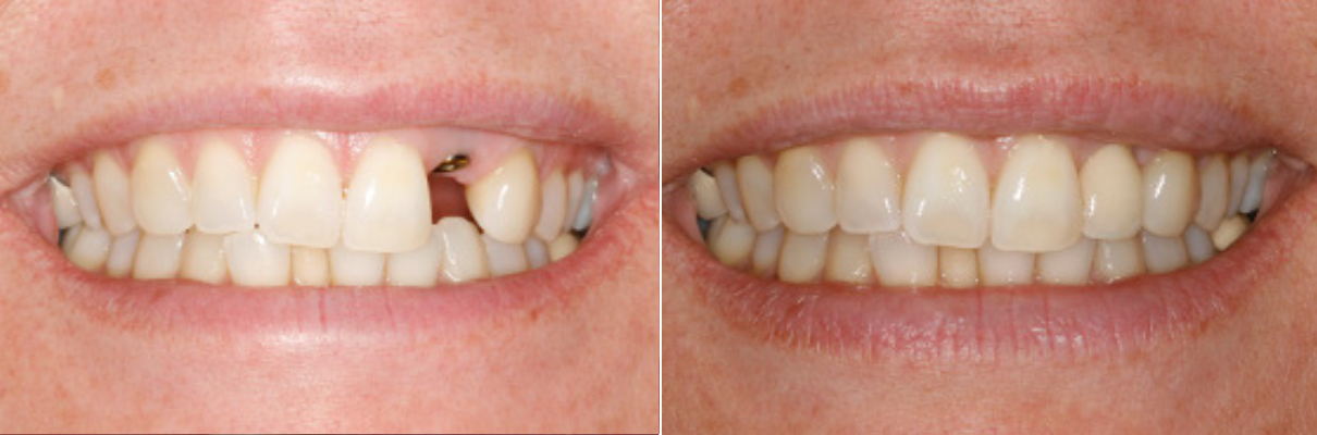 A before and after picture of a woman 's teeth.