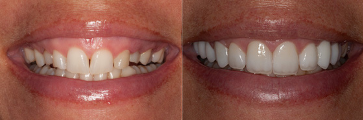 A before and after picture of a woman 's teeth.