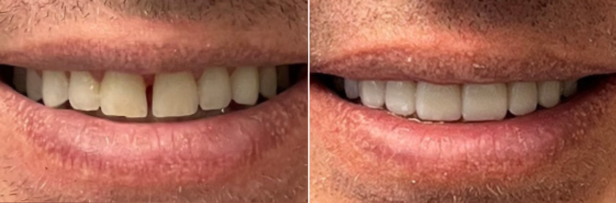 A before and after picture of a man 's teeth.