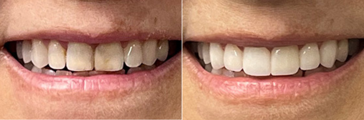 A before and after picture of a woman 's teeth.