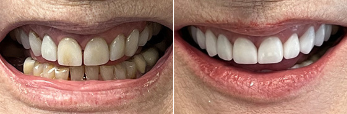 A before and after photo of a woman 's teeth.