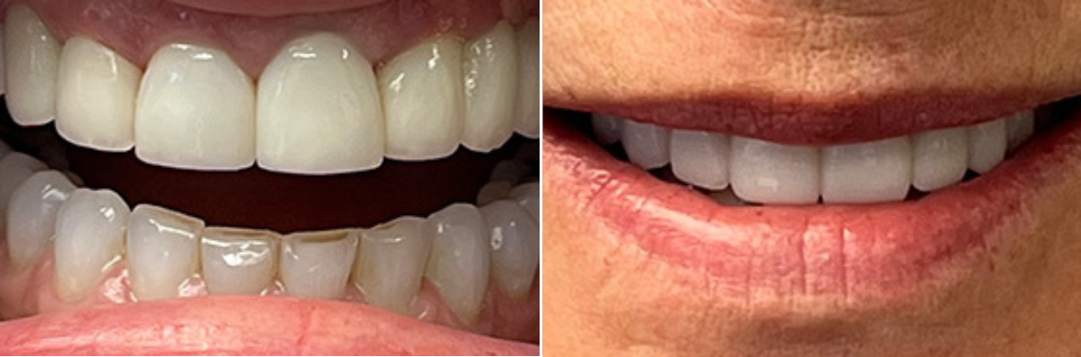 A before and after picture of a woman 's teeth.