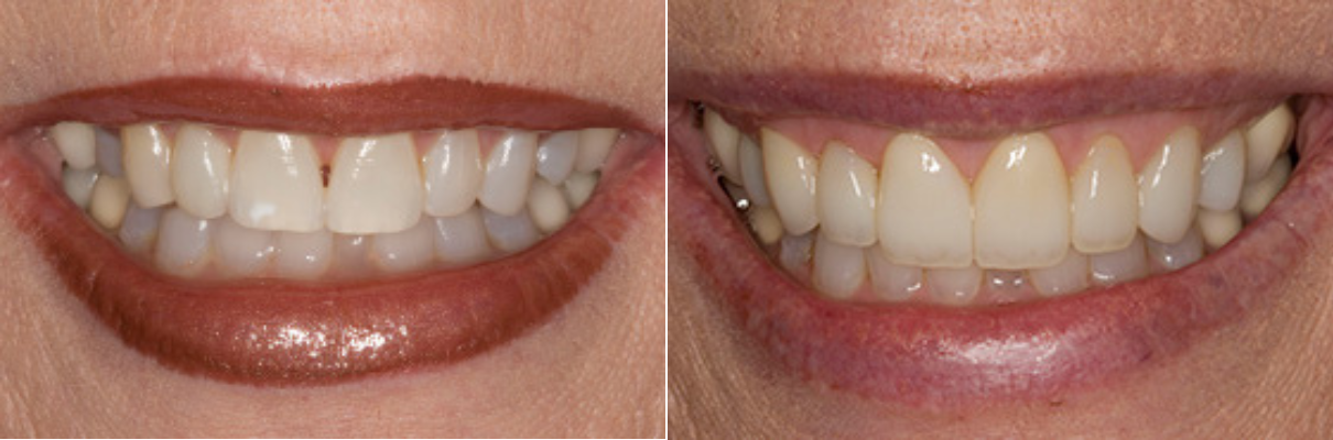 A before and after picture of a woman 's teeth.