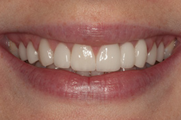 A close up of a woman 's smile with white teeth and red lips.