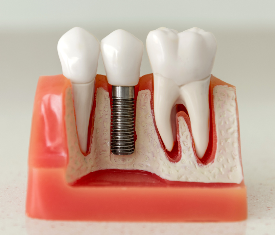 Dental implant model