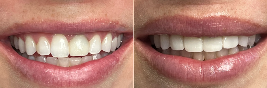Before and after comparison of a smile showing dental teeth whitening and alignment improvements.