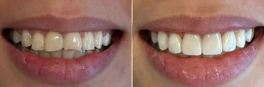Before and after photos showing dental restoration, with improved tooth shape, alignment, and color in the second image.