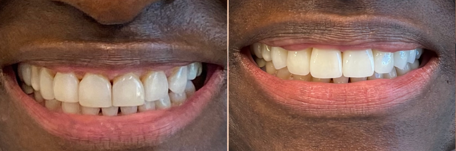 A side-by-side comparison showing teeth before and after dental treatment, featuring a brighter, more aligned smile.