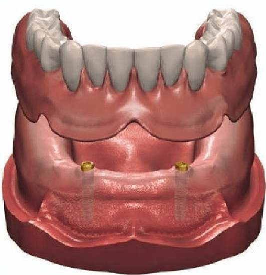 Modèle de prothèse dentaire avec dents supérieures et inférieures, fixées sur des gencives roses. Deux tenons en or sont visibles sur les gencives inférieures.