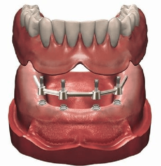 Modèle dentaire montrant une prothèse supérieure, une barre d'implant inférieure avec vis et une prothèse attachée.