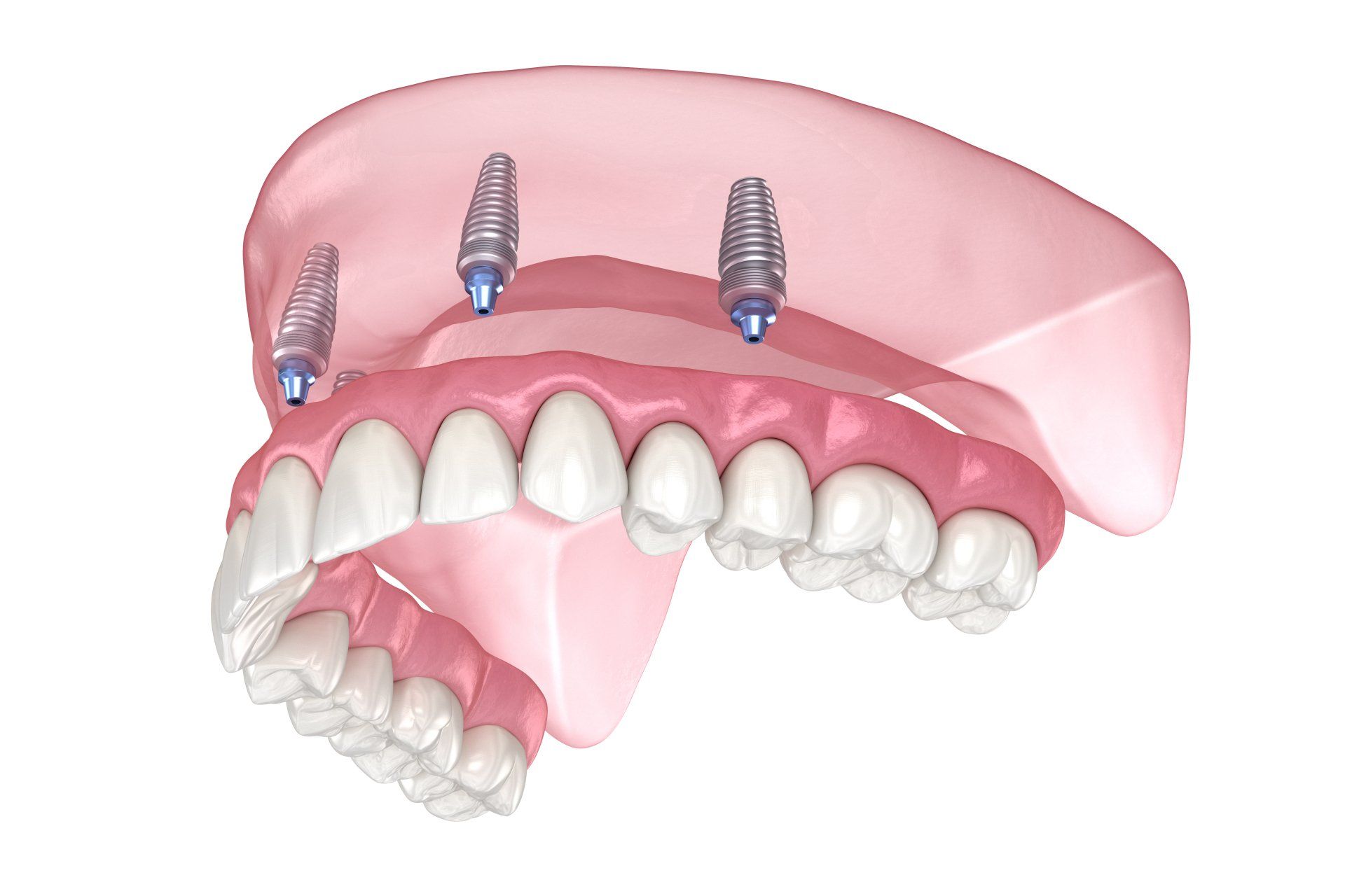 Prothèse dentaire sur implant : ensemble de dents inférieures fixées sur trois implants dans des gencives roses.