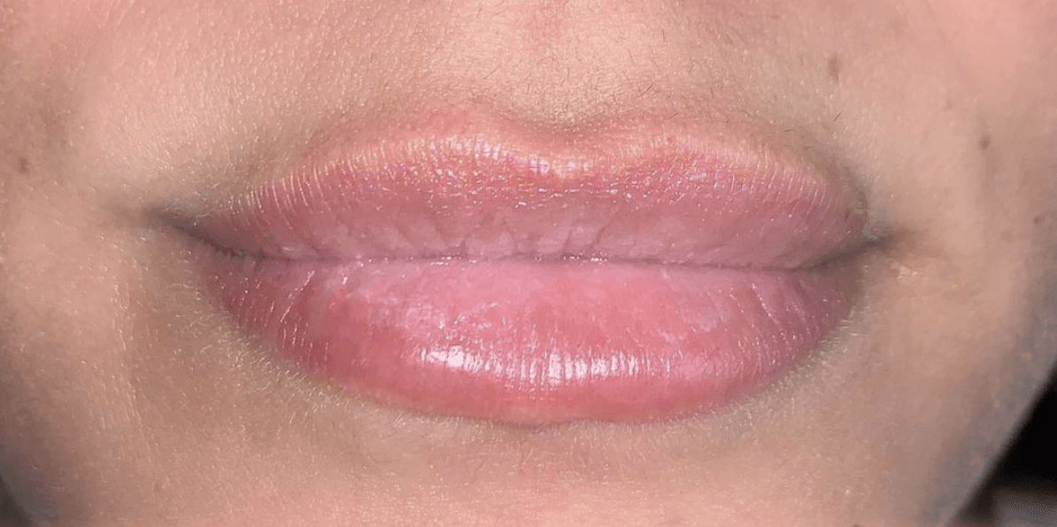 before lip fillers 3