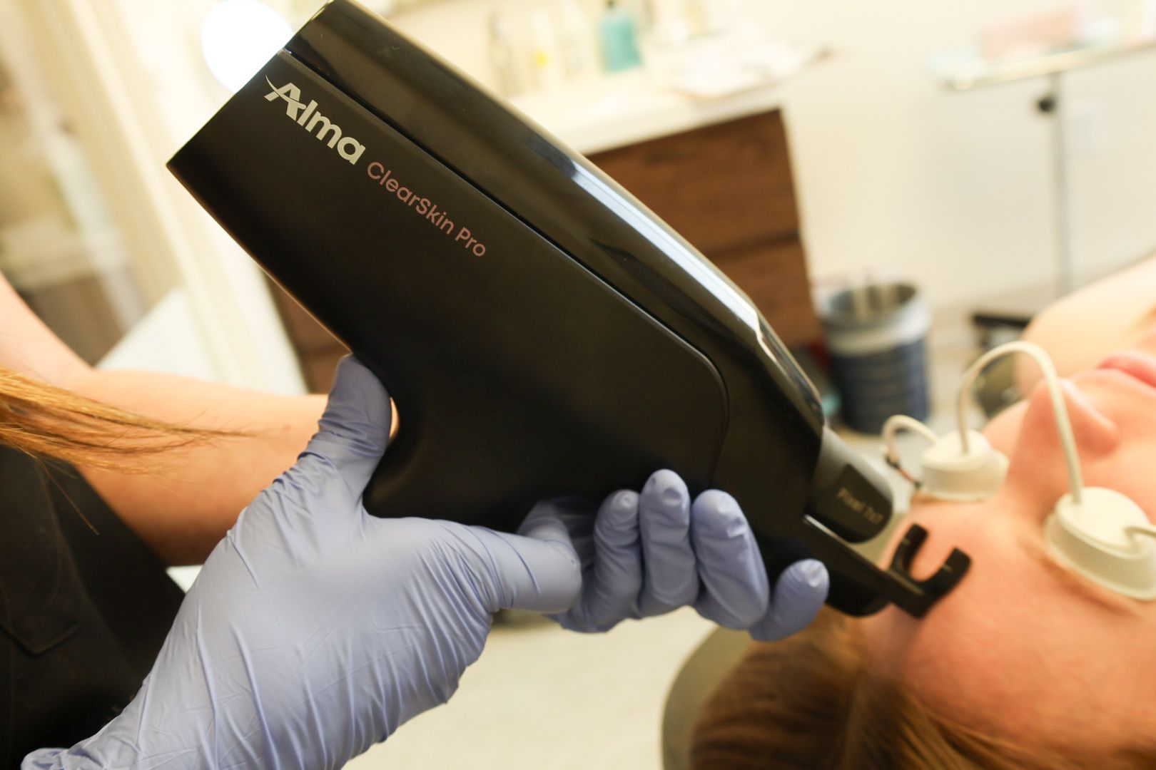 Person receiving laser treatment with Alma ClearSkin Pro device.